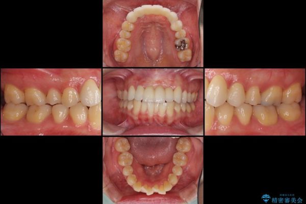 事故で抜けかけた歯　歯が溶けてしまった方の歯茎の再生、ブリッジ治療 治療後画像