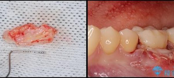 下がった歯茎を改善　歯肉移植による根面被覆 治療後画像