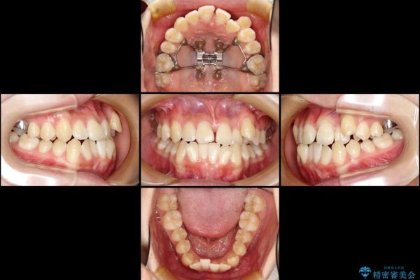 上顎の骨を拡大　抜歯せずに行う八重歯の矯正治療 治療前画像