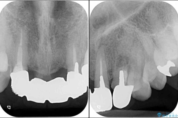 前歯がグラグラ　ブリッジの形も気に入らない 治療前画像