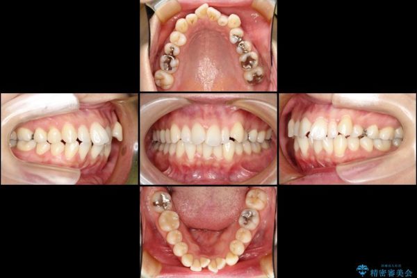 出っ歯を治したい　メタル装置による抜歯矯正治療 治療前画像