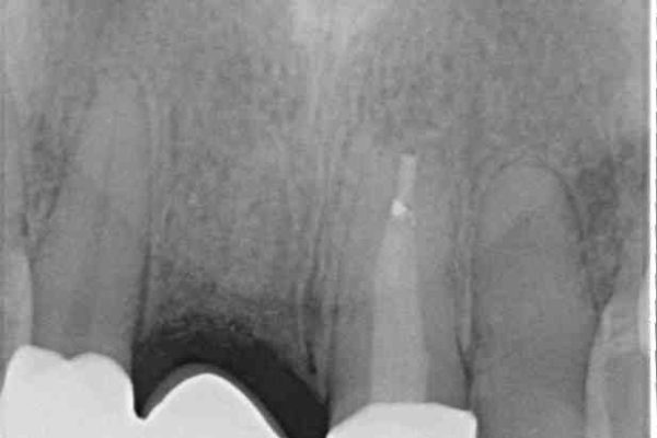 前歯が折れてしまった　歯肉移植を用いた前歯のブリッジ 治療後画像