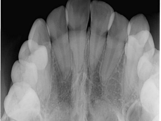 上顎の骨を拡大　抜歯せずに行う八重歯の矯正治療 治療後画像