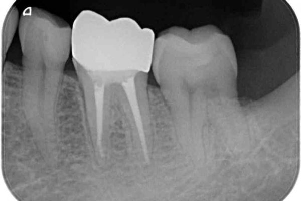 セラミックインレーとセラミッククラウン　奥歯のむし歯治療　 治療後画像
