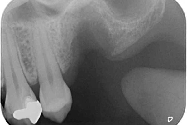上顎臼歯部におけるインプラント治療 治療前画像