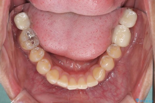 虫歯だらけの奥歯　セラミックやインプラントによる虫歯治療 治療後画像