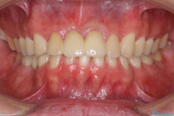 前歯が折れてしまった　歯肉移植を用いた前歯のブリッジ 治療後画像