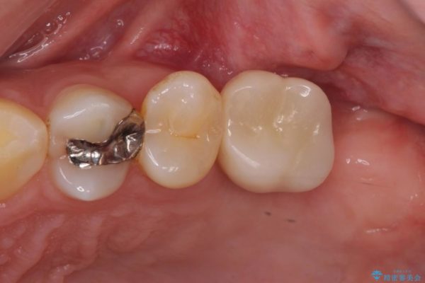 上顎臼歯部におけるインプラント治療 治療後画像