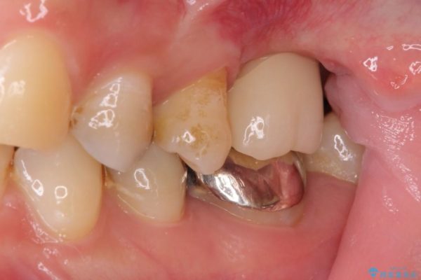 上顎臼歯部におけるインプラント治療 治療後画像