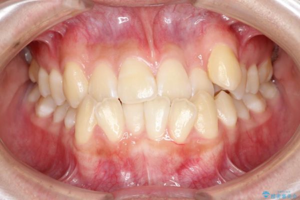 上顎の骨を拡大　抜歯せずに行う八重歯の矯正治療 治療前画像