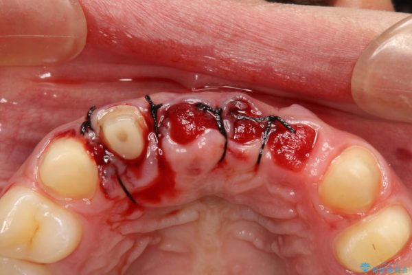 事故で抜けかけた歯　歯が溶けてしまった方の歯茎の再生、ブリッジ治療 治療前画像