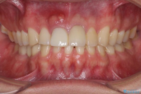 前歯が折れてしまった　歯肉移植を用いた前歯のブリッジ 治療前画像