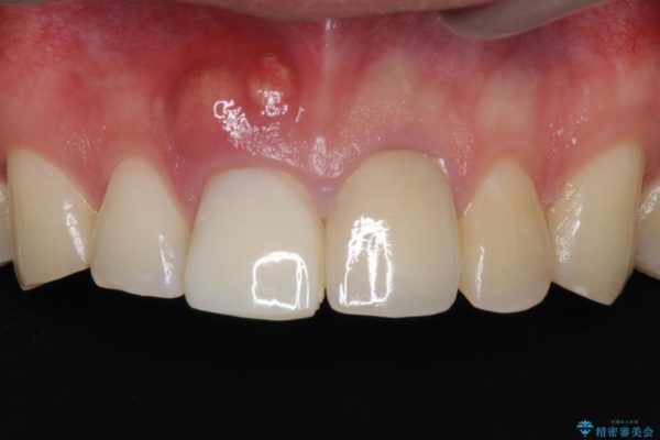前歯が折れてしまった　歯肉移植を用いた前歯のブリッジ 治療前画像