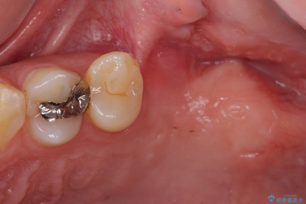 上顎臼歯部におけるインプラント治療 治療前