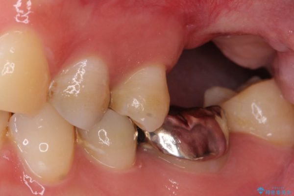 上顎臼歯部におけるインプラント治療 治療前画像