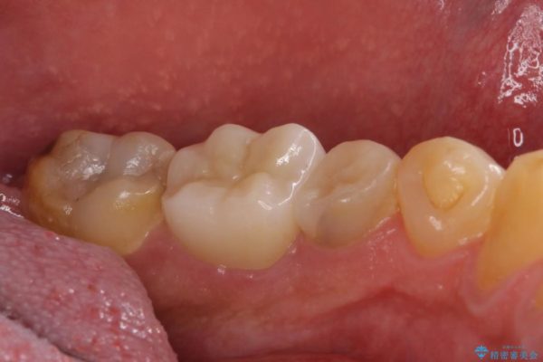 セラミックインレーとセラミッククラウン　奥歯のむし歯治療　 治療後画像