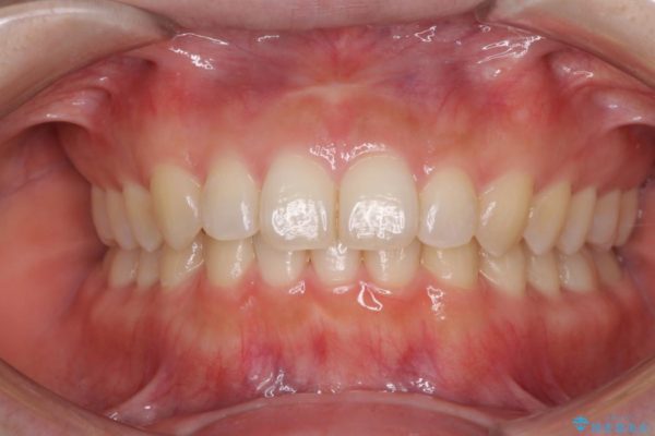 出っ歯を治したい　インビザラインによる矯正治療 治療前画像