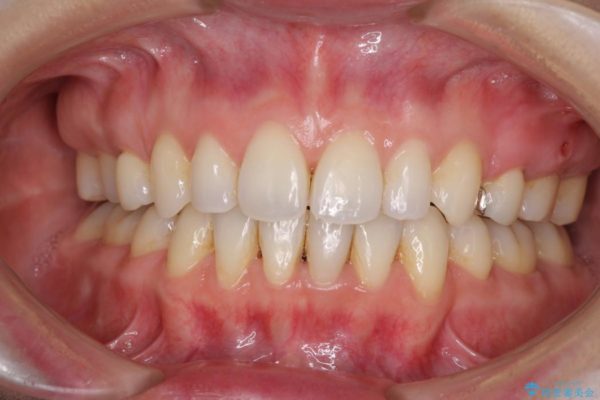 出っ歯を治したい　メタル装置による抜歯矯正治療 治療後画像
