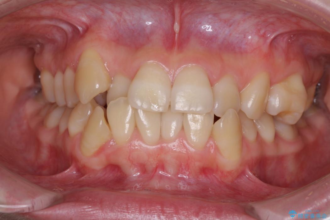 歯並びのでこぼこが気になって口を開けて笑えない　表側の目立たない装置での抜歯矯正 治療前