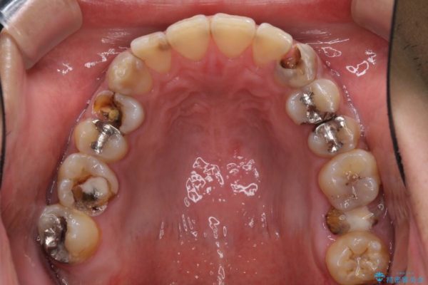 虫歯だらけの奥歯　セラミックやインプラントによる虫歯治療 治療前画像