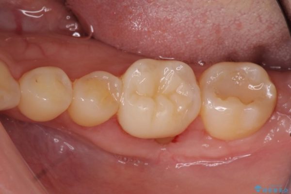 下がった歯茎を改善　歯肉移植による根面被覆 治療前画像
