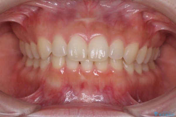 出っ歯を治したい　インビザラインによる矯正治療 治療後画像
