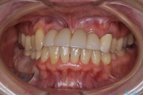 前歯がグラグラ　ブリッジの形も気に入らない 治療前画像