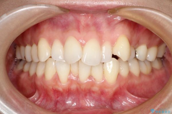 出っ歯を治したい　メタル装置による抜歯矯正治療 治療前画像