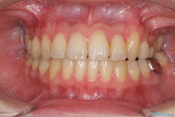 結婚式までに前歯を整えたい　上顎骨の拡大を併用した抜歯矯正 治療後画像