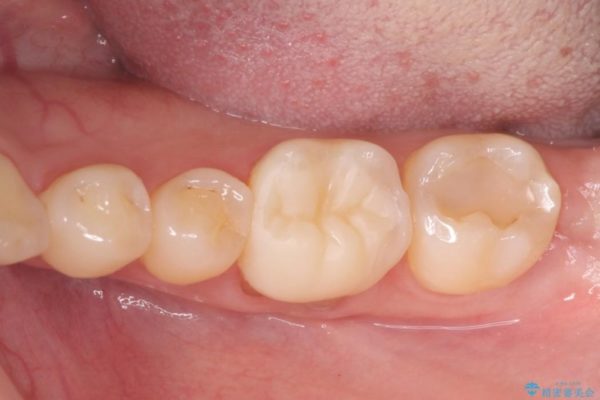 下がった歯茎を改善　歯肉移植による根面被覆 治療後画像