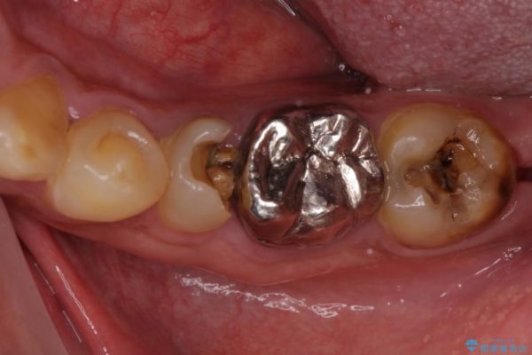 セラミックインレーとセラミッククラウン　奥歯のむし歯治療　 治療前画像