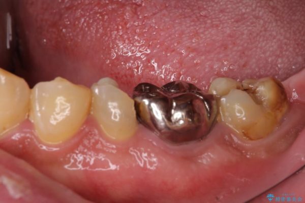 セラミックインレーとセラミッククラウン　奥歯のむし歯治療　 治療前画像