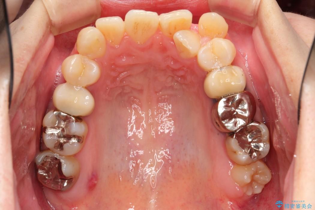 結婚式までに前歯を整えたい　上顎骨の拡大を併用した抜歯矯正 治療前