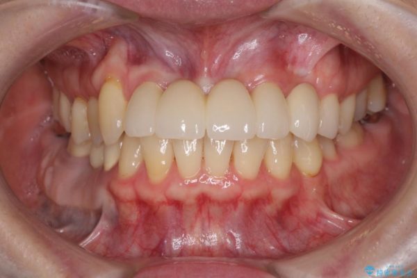 前歯がグラグラ　ブリッジの形も気に入らない 治療後画像