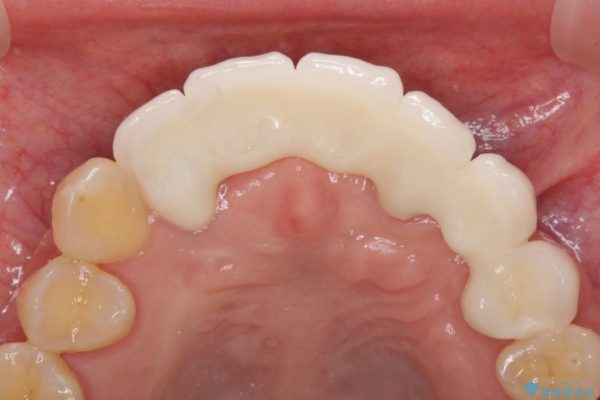 前歯がグラグラ　ブリッジの形も気に入らない 治療後画像