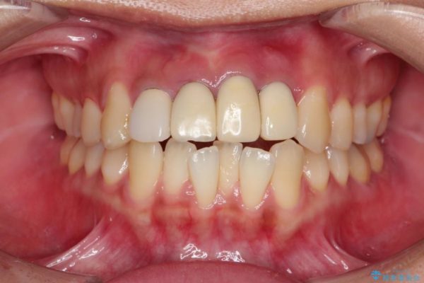 事故で抜けかけた歯　歯が溶けてしまった方の歯茎の再生、ブリッジ治療 治療前画像