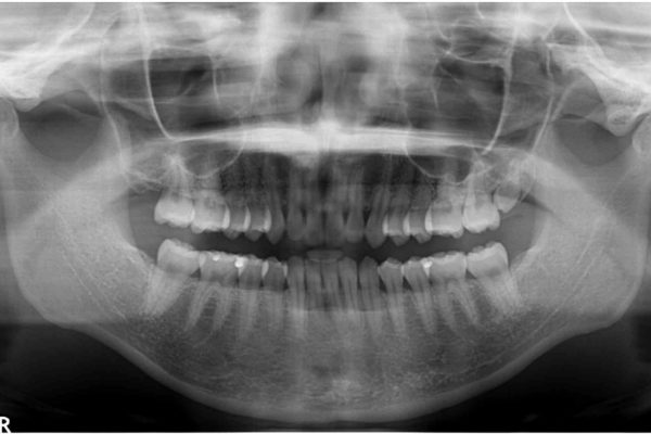 出っ歯を治したい　インビザラインによる矯正治療 治療前画像