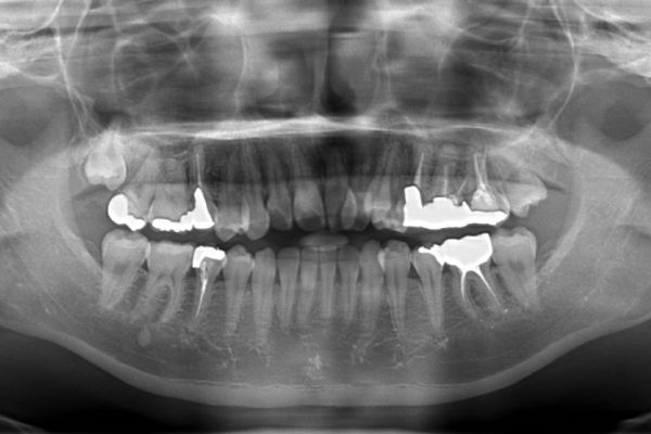 結婚式までに前歯を整えたい　上顎骨の拡大を併用した抜歯矯正 治療前画像