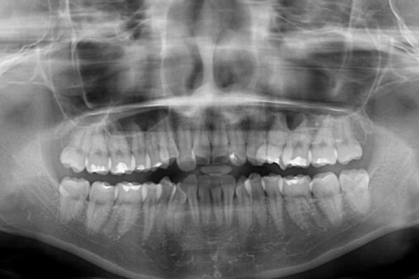 歯並びのでこぼこが気になって口を開けて笑えない　表側の目立たない装置での抜歯矯正 治療前画像