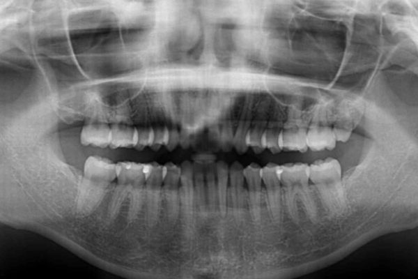 出っ歯を治したい　インビザラインによる矯正治療 治療後画像