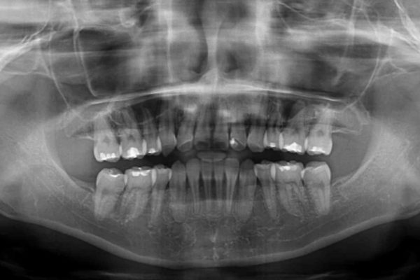 歯並びのでこぼこが気になって口を開けて笑えない　表側の目立たない装置での抜歯矯正 治療後画像