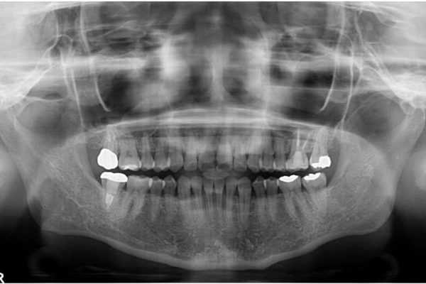 インビザラインで前歯のでこぼこをきれいに 治療後画像