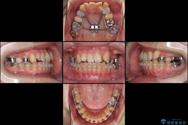 結婚式までに前歯を整えたい　上顎骨の拡大を併用した抜歯矯正 治療前画像