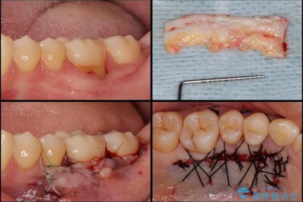 下がった歯茎を改善　歯肉移植による根面被覆 治療前画像