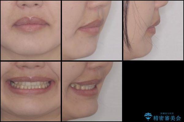 前歯の出っ歯を抜歯矯正で改善　整った歯並びに 治療後画像