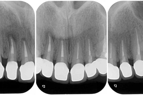 金属の色が見えてしまった前歯をオールセラミックに 治療後画像