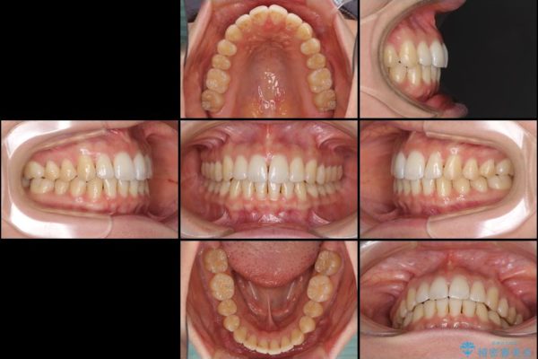 インビザラインで前歯のでこぼこを改善 治療後画像
