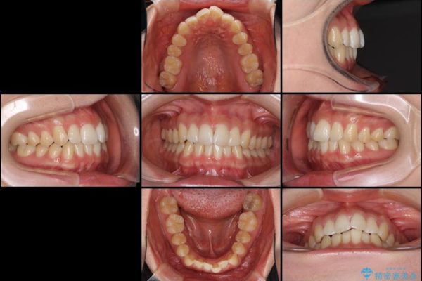 インビザラインで前歯のでこぼこを改善 治療前画像