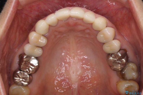 金属の色が見えてしまった前歯をオールセラミックに 治療後画像