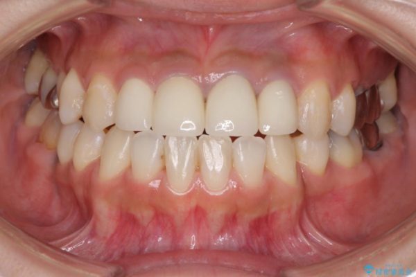 ホワイトニングで白くなった歯の色に合わせて補綴を入れたい 治療後画像